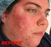 acne_rosacea_fix-Color_Mechanic_0004_Layer 0.jpg