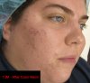 acne_rosacea_fix-Color_Mechanic_0002_annotated_ after color mech.jpg